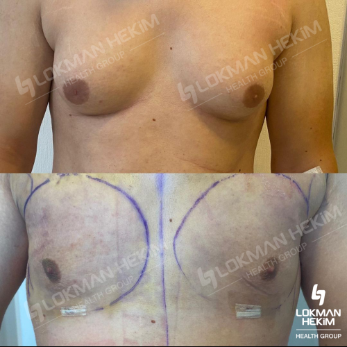 Pubic liposuction Before / After photo